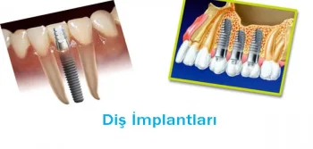 Diş İmplantları